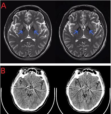 Case report: Asymmetric bilateral deep brain stimulation for the treatment of pantothenate kinase-associated neurodegeneration in a patient: a unique case of atypical PKAN with a novel heterozygous PANK2 mutation